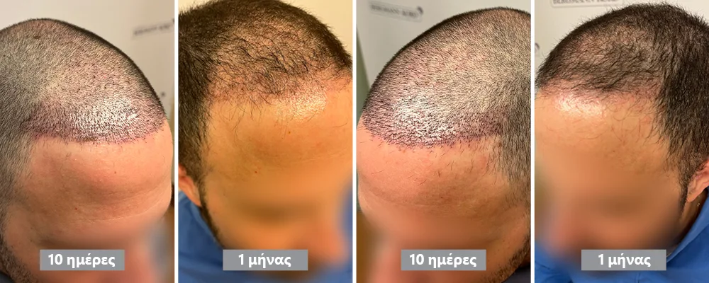 Shock Loss Μεταμόσχευσης Μαλλιών 1 μήνα μετά