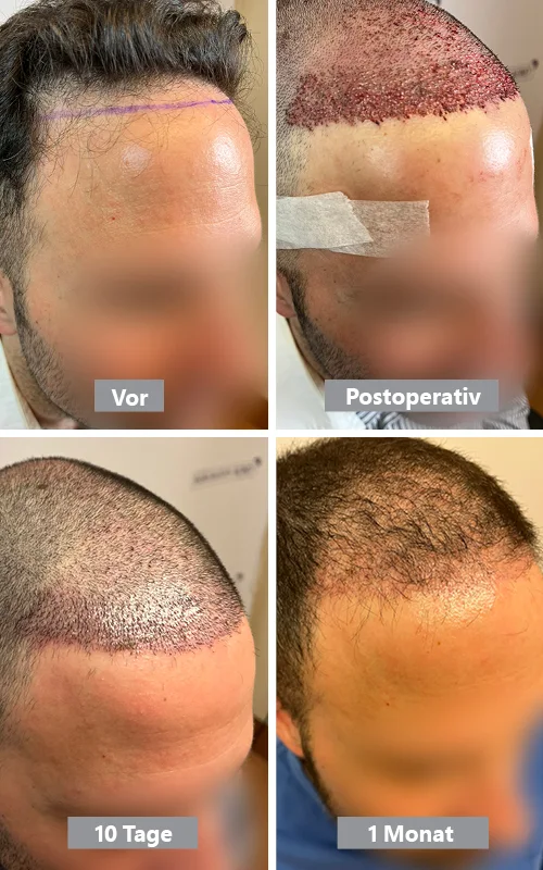 Ergebnis des Schockverlusts 1 Monat danach