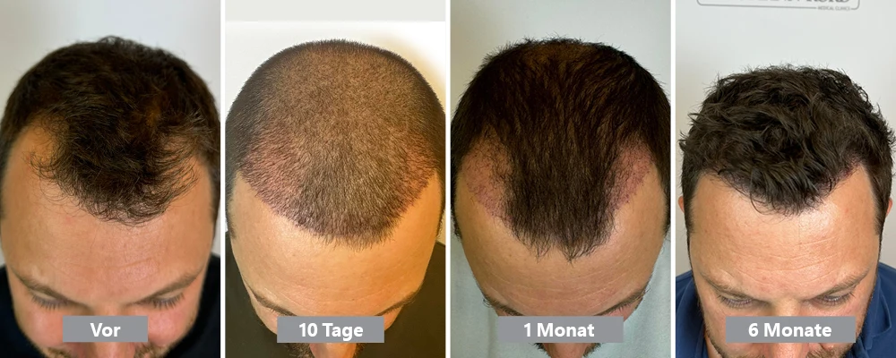 Ergebnis einer Haartransplantation