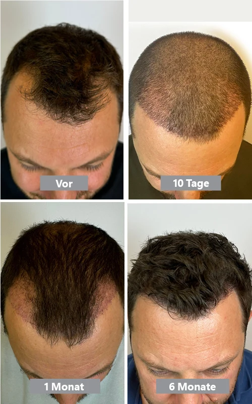 Ergebnis einer Haartransplantation