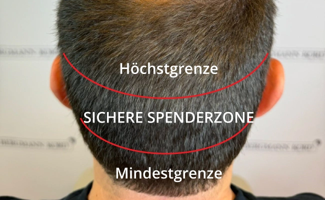 Spernderbereich Haartransplantation
