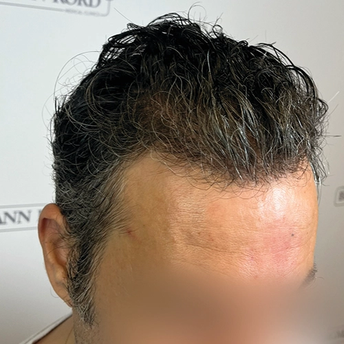 Μετά μεταμόσχευση μαλλιών Bergmann Kord