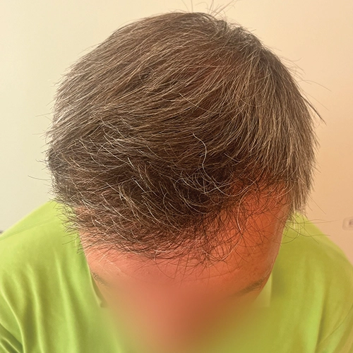 Μετά μεταμόσχευση μαλλιών Bergmann Kord