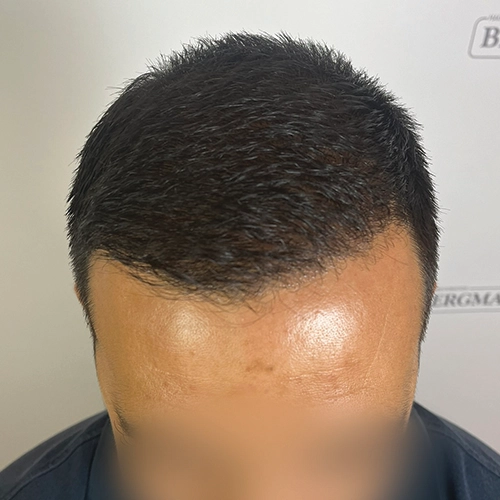 Μετά μεταμόσχευση μαλλιών Bergmann Kord