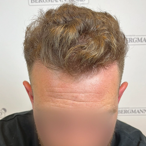 Μετά μεταμόσχευση μαλλιών Bergmann Kord
