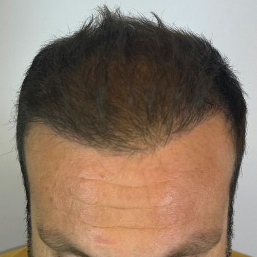 Μετά μεταμόσχευση μαλλιών Bergmann Kord