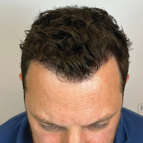 Μετά μεταμόσχευση μαλλιών Bergmann Kord