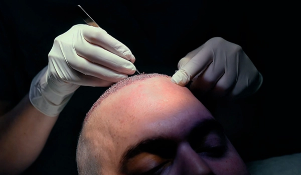 Μεταμόσχευση Μαλλιών FUE Bergmann Kord