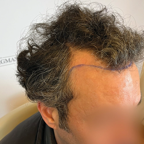 Πριν μεταμόσχευση μαλλιών Bergmann Kord