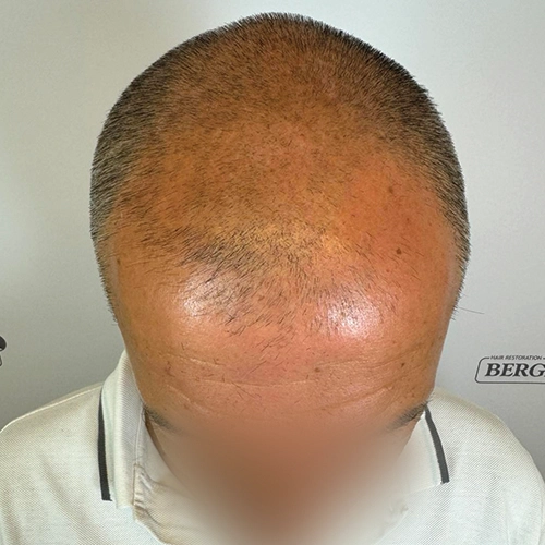 Πριν μεταμόσχευση μαλλιών Bergmann Kord