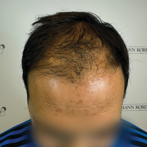 Πριν μεταμόσχευση μαλλιών Bergmann Kord