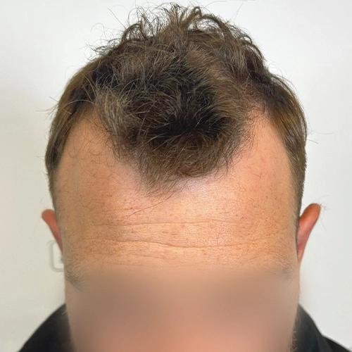 Πριν μεταμόσχευση μαλλιών Bergmann Kord