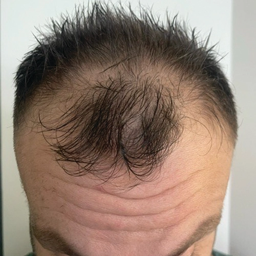 Πριν μεταμόσχευση μαλλιών Bergmann Kord