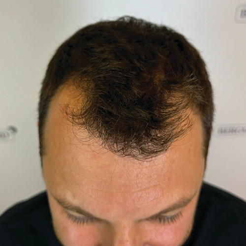 Πριν μεταμόσχευση μαλλιών Bergmann Kord