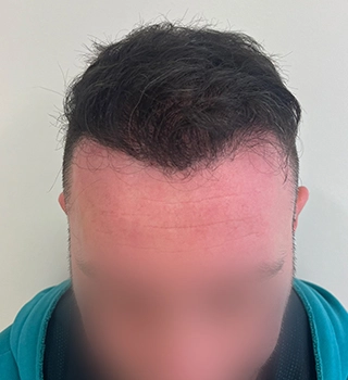 12 months result Bergmann Kord
