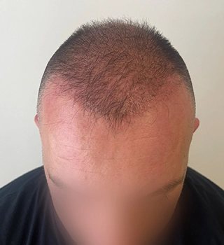 3 months result Bergmann Kord