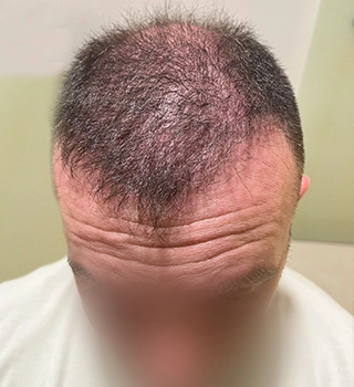 6 months result Bergmann Kord