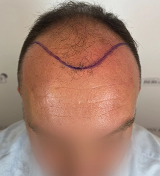 Day of procedure Bergmann Kord