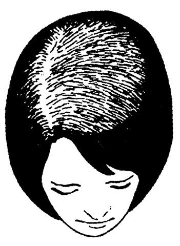 Ludwig classification of hair loss. Type 1.