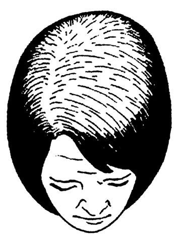 Классификация выпадения волос по Людвигу. Женское облысение и стадии. Этап 2.